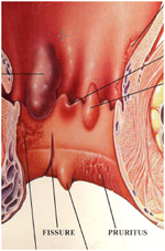 Diagram of a fissure in ano