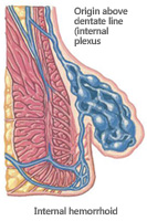 Internal Hemorrhoid Diagram