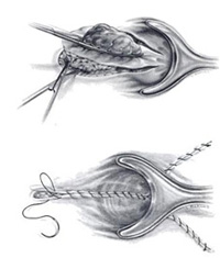 Open Surgery Hemorrhoid Treatment