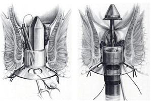 Stapled Hemorrhoid Treatment